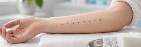 Unterarm mit nummerierten Testpunkten beim Allergie-Prick-Test auf weißem Tuch in heller klinischer Umgebung